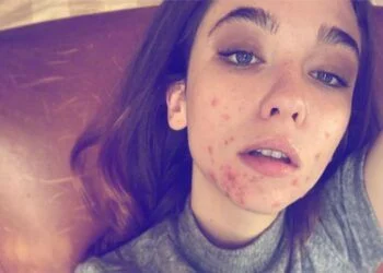 Actress Matilda De Angelis ('The Undoing') Publishes A Photo Of Her Cystic Acne And The Internet Applauds