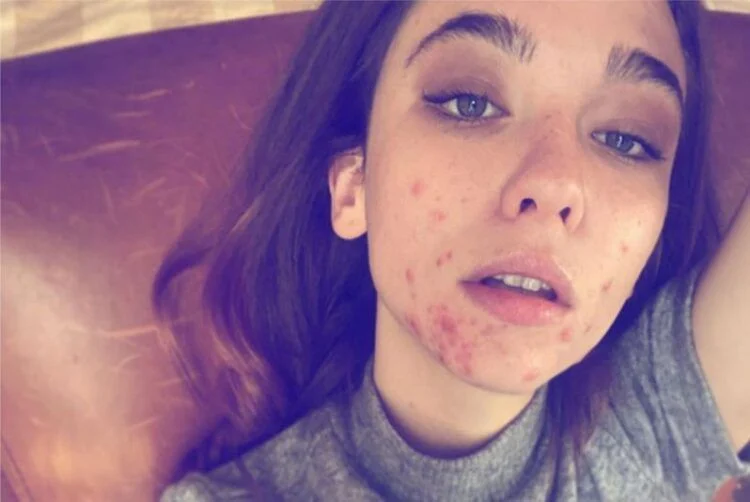 Actress Matilda De Angelis ('The Undoing') Publishes A Photo Of Her Cystic Acne And The Internet Applauds